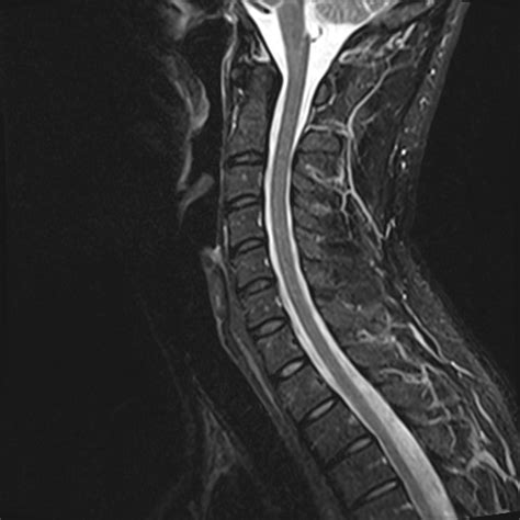 Normal Cervical Spine MRI Image Radiopaedia Org