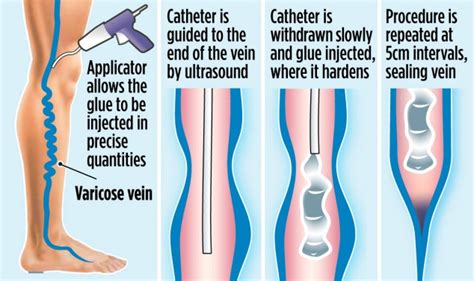 Superglue That Can Banish Your Varicose Veins In 30 Minutes Daily