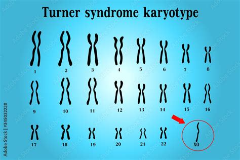 Karyotype Of Turner Syndrome Ts Also Known X Or X Is A