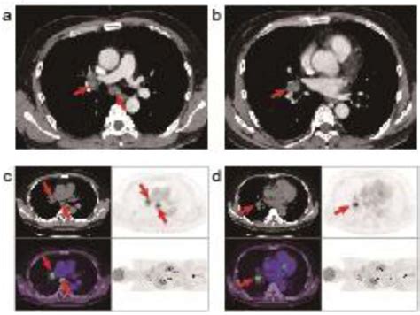 Findings On Imaging Of Lesions In Hilar And Mediastinal Lymph Nodes