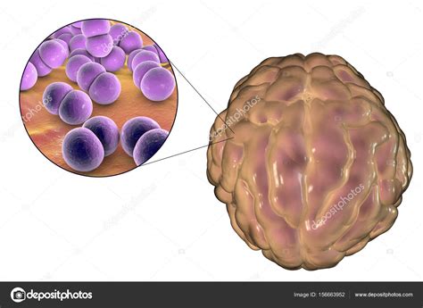 Imágenes Meningitis Infección De Meningitis Causada Por Bacterias