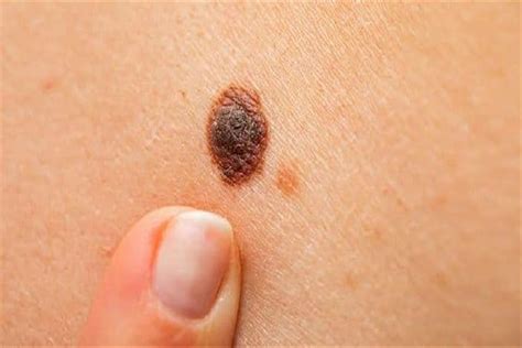 5 علامات تكشف إصابتك بـ سرطان الجلد مصراوى
