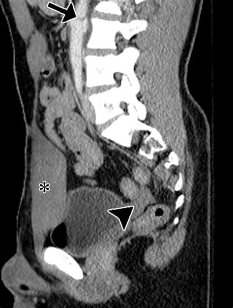 Ct Of Major Vascular Injury In Blunt Abdominopelvic Trauma Radiographics