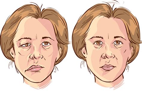 Bell palsy is a diagnosis of exclusion. What Causes Bell's Palsy? | My Little Bird