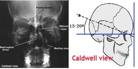 Nasal Bone X Ray Ap View Nasal Bones Superoinferior Axial