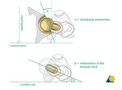 Ensure Correct Rotational Alignment Normal Anteversion Of Both
