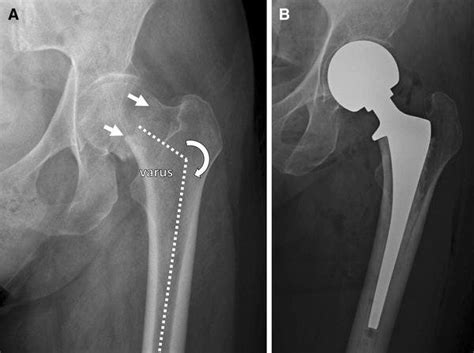 73 Year Old Woman With A Varus Impacted Femoral Neck Fracture Ap