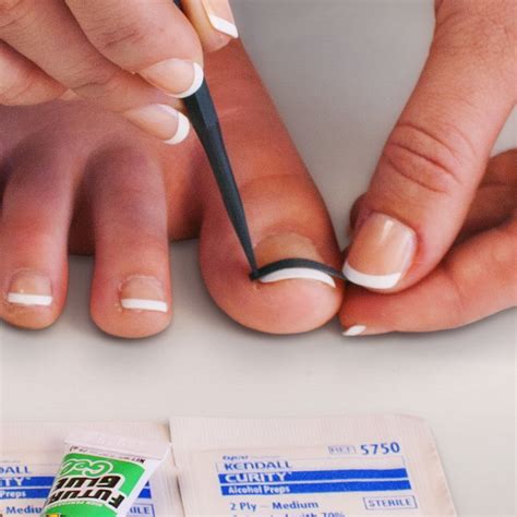 Curvecorrect Ingrown Nail Treatment Kit Product Reviews