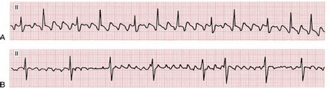 Atrial Flutter Vs Atrial Fibrillation Startguru