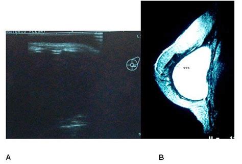 Evaluation Of The Rupture Of Silicone Breast Implants By Mammography