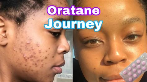 Oratane Journey From Day One To The End YouTube