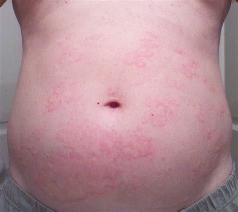 Allergic Reaction Rash To Laundry Detergent Causes Symptoms And