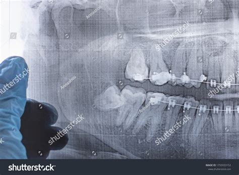 Wisdom Tooth On Xray Closeup Brace Stock Photo 1755933152 Shutterstock