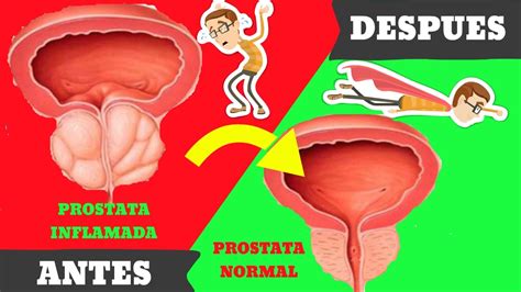 Vivere in modo sano sulla prostata. Remedio Casero Para Prostata Inflamada Y Evitar Cirugia ...