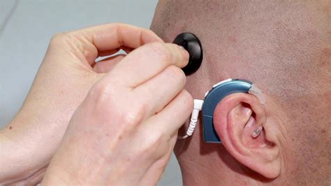 How Do Cochlear Implants Work Cochlear Implants