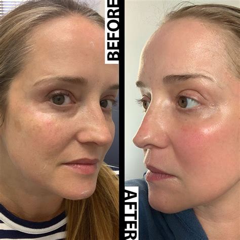 Laser Facial Treatment Before And After Healthy Anozo