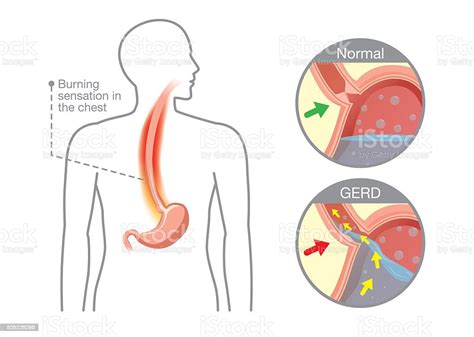 Cause Of Gastroesophageal Reflux Disease In Human Stomach Stock Vector