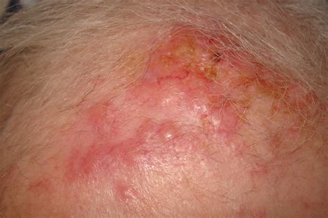 Skin Metastases From Lung Cancer