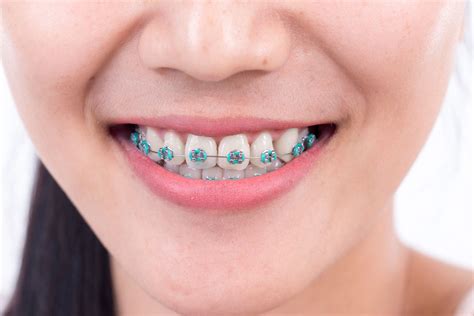 Bands for an overbite start further forward in the mouth, near the canines, on the top of the mouth. The Purpose of Elastic Ligatures on Braces