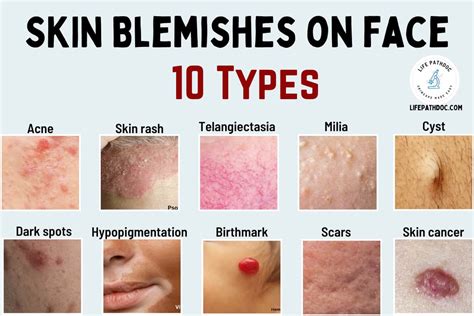 10 Types Of Skin Blemishes On Face And How To Get Rid Of Them