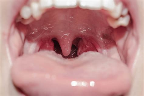 Bumps On The Back Of Tongue Causes Symptoms And Treatments