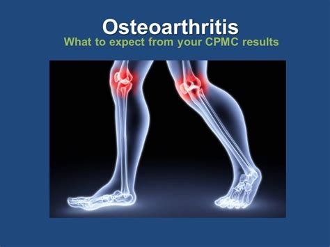 Osteoarthritis Youtube
