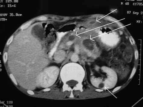 Primary Disseminated Extrahepatic Abdominal Hydatid Cyst A Rare