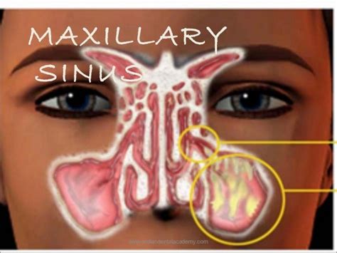 Maxillary Sinus Certified Fixed Orthodontic Courses By Indian Dental