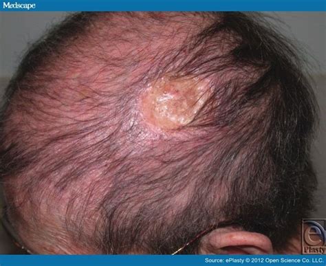 Scalp Reconstruction And Acellular Dermal Matrix Skin Graft