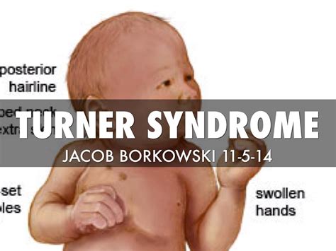 Turner Syndrome By Jacob Borkowski
