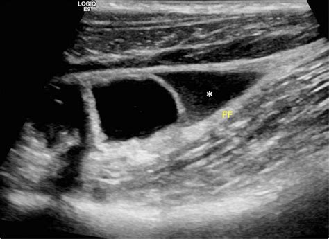 Acute Appendicitis In A 10 Year Old Boy Longitudinal Ultrasound Image