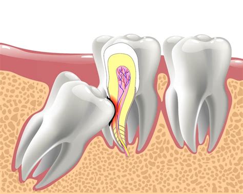 Impacted Wisdom Tooth 6 Signs State College Dr Donald Marks Donald
