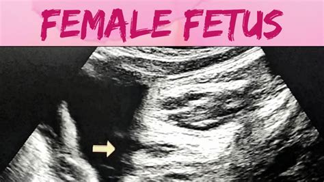 Female Fetus Gender Identification Scan Fetal Sex Determination Youtube