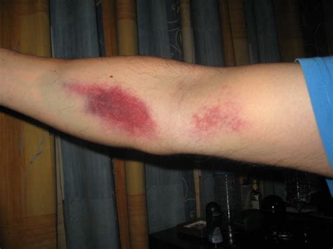 What do you do with bruise arm after draw blood? 3572200651_b6a83ff36f_z.jpg