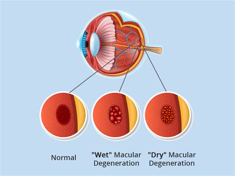 Age Related Macular Degeneration Amd Eye Disease And Treatment Jeh