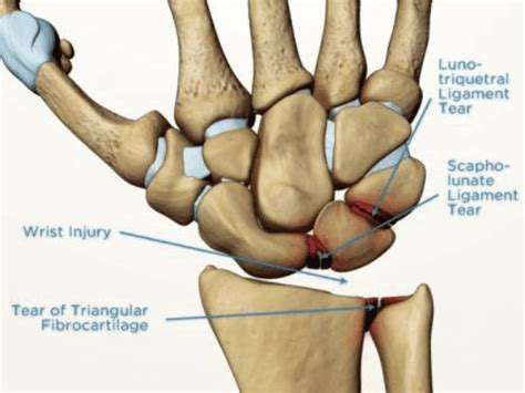Ligament Injuries Teton Hand Surgery