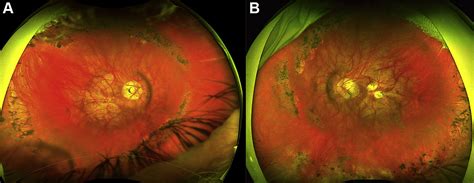 Strikingly High Myopia In Aland Island Eye Disease Ophthalmology