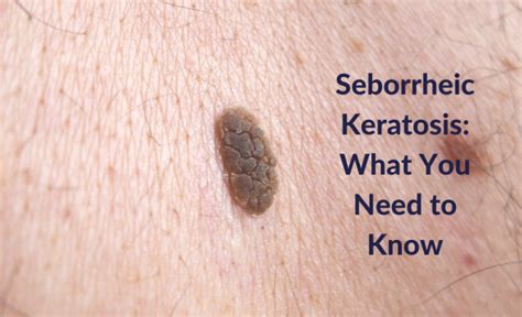 Seborrheic Keratosis Sks What You Need To Know Bend Dermatology Clinic