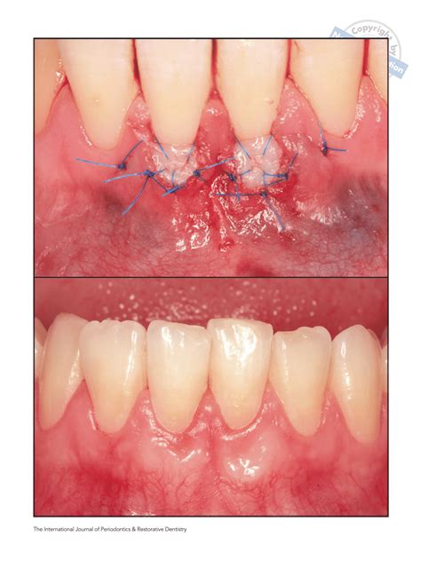 Pdf Treatment Of Gingival Recession In The Anterior Mandible Using