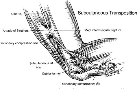 Figure 3 From The Failed Ulnar Nerve Transposition Semantic Scholar