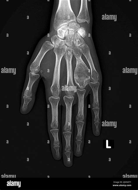 Aneurysmal Bone Cyst Of The Hand X Ray Stock Photo Alamy