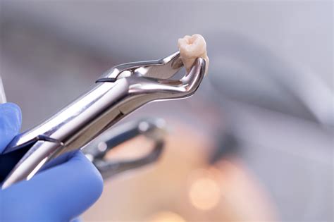 Tooth Extraction Healing Timeline