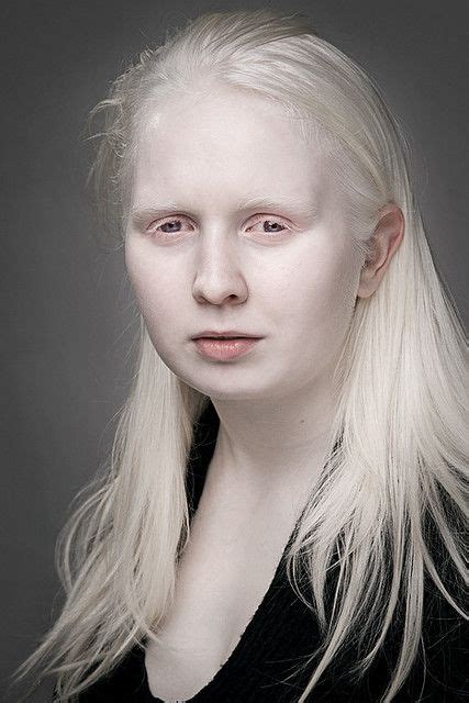 Cecilie Albino Girl Albinism Crystal Blue Eyes