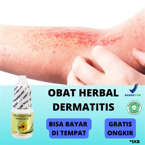 Obat Dermatitis Untuk Gatal Gatal Dermatitis Seboroik Dermatitis