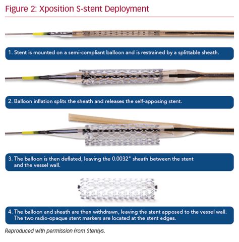 Xposition S Stent Deployment Radcliffe Cardiology