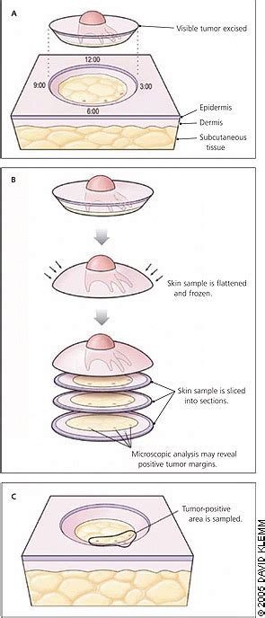 Mohs Micrographic Surgery Aafp