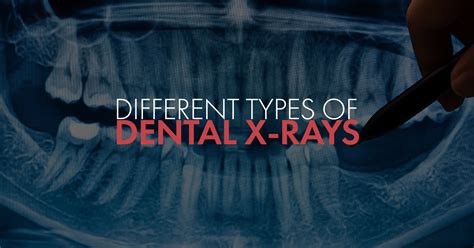Different Types Of Dental X Rays Flawless Dental