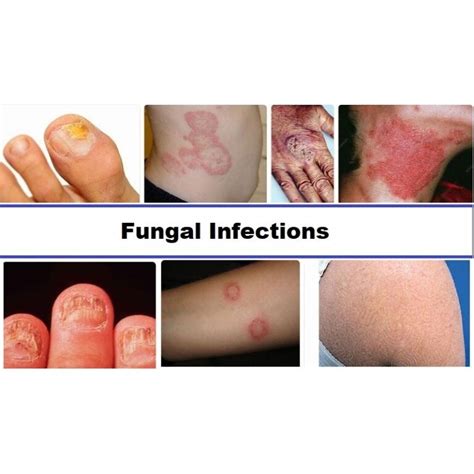 Fungal Infections Iimt University Official Blog Explore More
