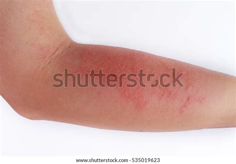 Allergic Rash Dermatitis Eczema Skin Patient Stock Photo 535019623