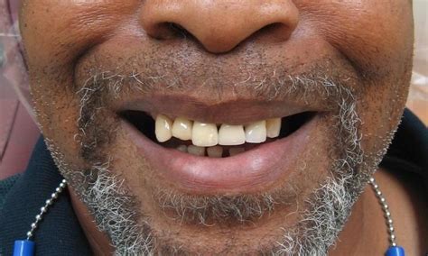 Full Upper Dentures Before And After Dentist West Palm Beach Fl